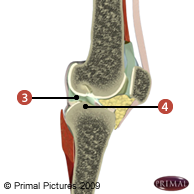 Figure où on identifie: 3. Une cavité articulaire, et 4. Du liquide synoviale.