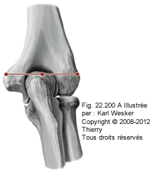 Figure du coude en extention, où les épicondyles et l'olécrâne forment une ligne droite.