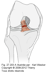 Figure d'une déchirure du croisé antérieur du genou