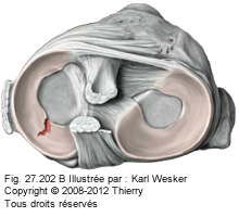 Figure 2 de 2 d'une déchirure méniscale.