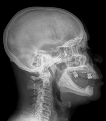 Rayon-X d'un patient atteint de cervicarthrose.