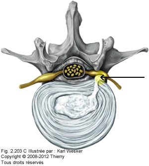 Figure 1 de 2 d'une hermie discale.