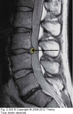 Figure 2 de 2 d'une hermie discale.